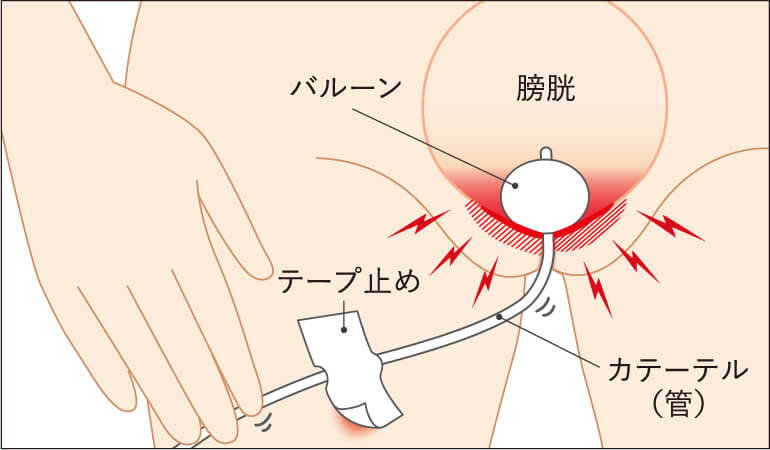 抜去や内部の炎症・感染
