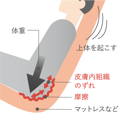 局所的な減圧が肝心