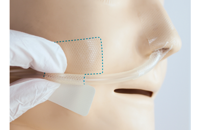 上手な経鼻チューブの固定方法（ほほ）｜クリアホールド貼り方・はがし方ガイド（写真・動画付き）の画像