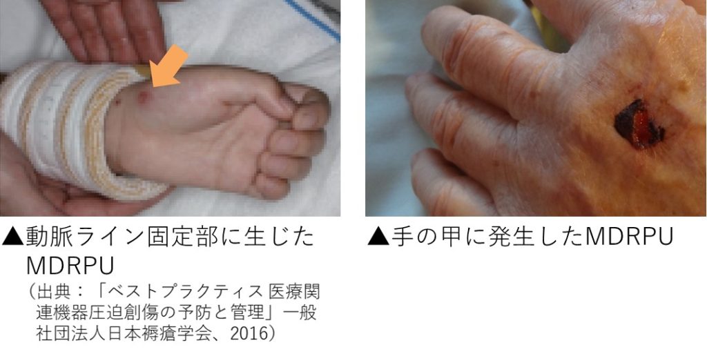 ロックナット部の圧迫で発生してしまったMDRPU