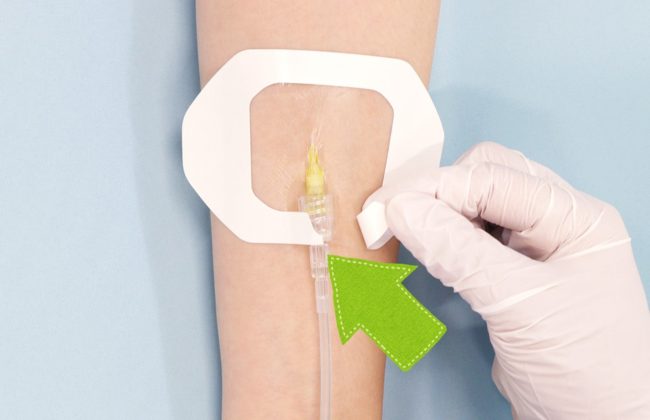 末梢静脈カテーテル固定フィルムのわかりやすい貼り方【エアウォールIV　フレームタイプ】の画像