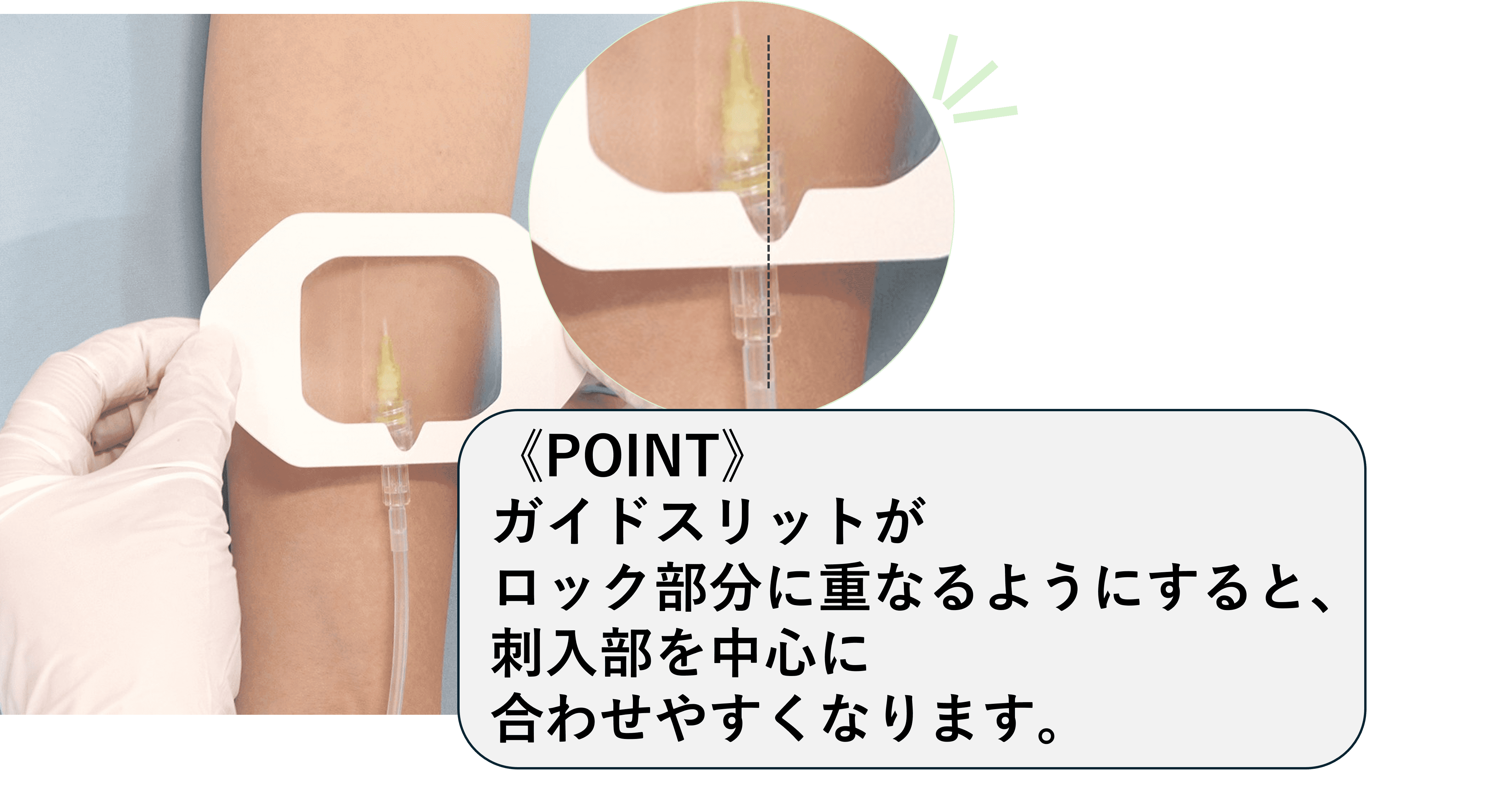 末梢静脈カテーテル固定フィルムのわかりやすい貼り方【エアウォールIV　フレームタイプ】の画像