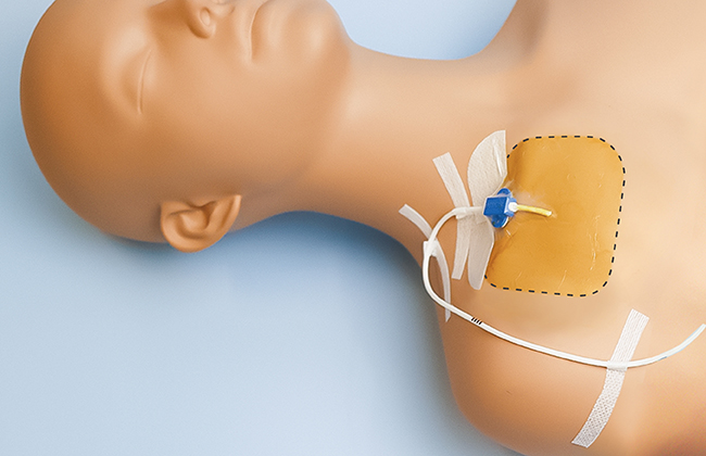 中心静脈カテーテル固定フィルムのわかりやすい貼り方【エアウォールIV切り込みタイプ】の画像
