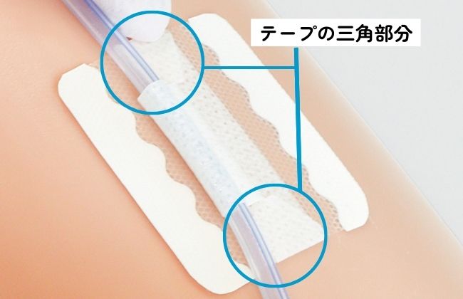 尿道カテーテル・ドレーンチューブ固定テープのわかりやすい貼り方・はがし方【クリアホールドライナー】の画像