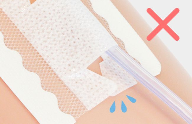 尿道カテーテル・ドレーンチューブ固定テープのわかりやすい貼り方・はがし方【クリアホールドライナー】の画像