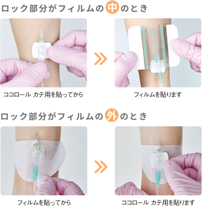 滅菌フィルムの中でもでも使える