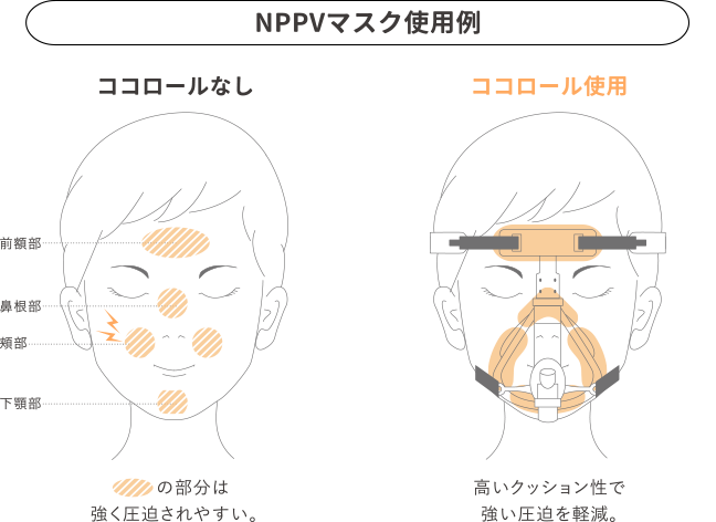 NPPVマスク使用例