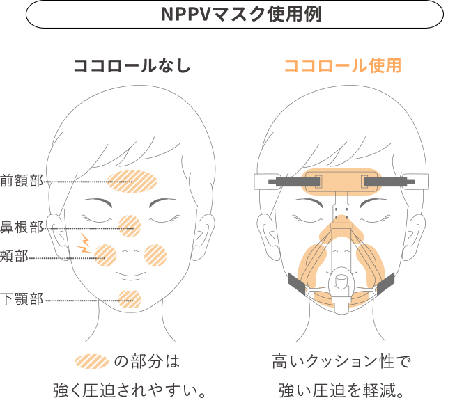 NPPVマスク使用例