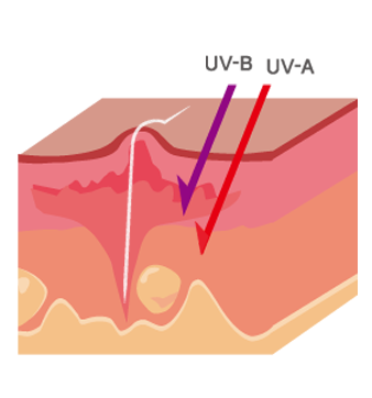 傷ついた肌はUV-A・UV-Bの影響を受けやすい