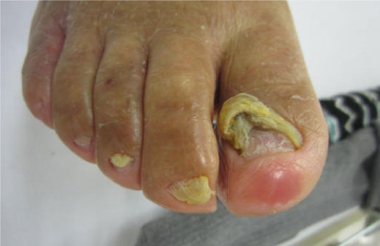 足趾切断や足趾の皮膚損傷患者