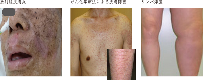 がん治療における皮膚の脆弱性