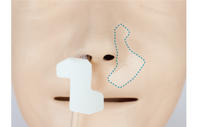 上手な経鼻チューブの固定方法（はな）｜クリアホールド貼り方・はがし方ガイド（写真・動画付き）の画像