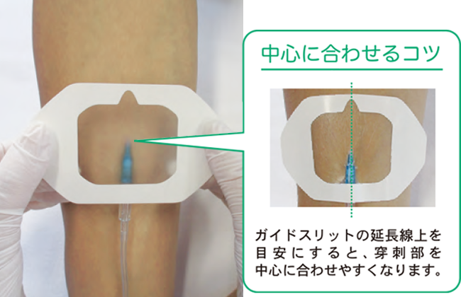 末梢静脈カテーテル固定フィルムのわかりやすい貼り方【エアウォールIV　フレームタイプ】の画像