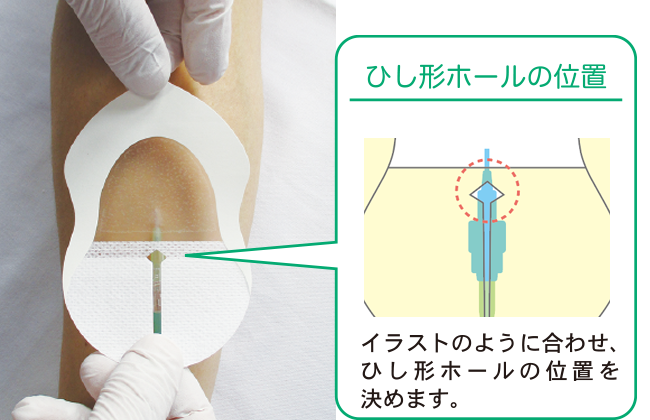 末梢静脈カテーテル固定フィルムのわかりやすい貼り方【エアウォールIV　切り込みタイプ】の画像