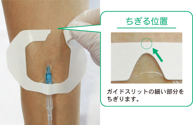 末梢静脈カテーテル固定フィルムのわかりやすい貼り方【エアウォールIV　フレームタイプ】の画像