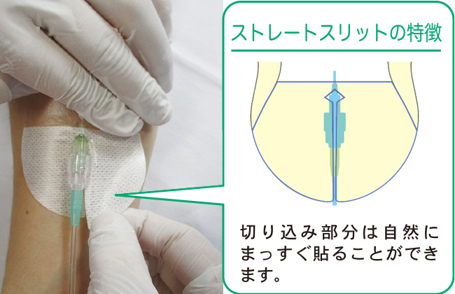 末梢静脈カテーテル固定フィルムのわかりやすい貼り方【エアウォールIV　切り込みタイプ】の画像