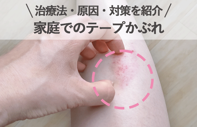 これは水泳選手のかゆみとどう違うのですか?